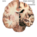 Alzheimer. Datos básicos