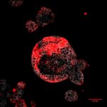 Hallaron las celulas que causan metástasis en el cáncer de colon