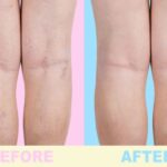 *Las varices en mujeres y hombres es una patología peligrosa. Sin embargo, hoy en día se puede controlarla fácilmente desde tu casa*