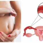 SALUD: Qué es un embarazo ectópico, el cuadro clínico que puso en riesgo la salud de María Becerra